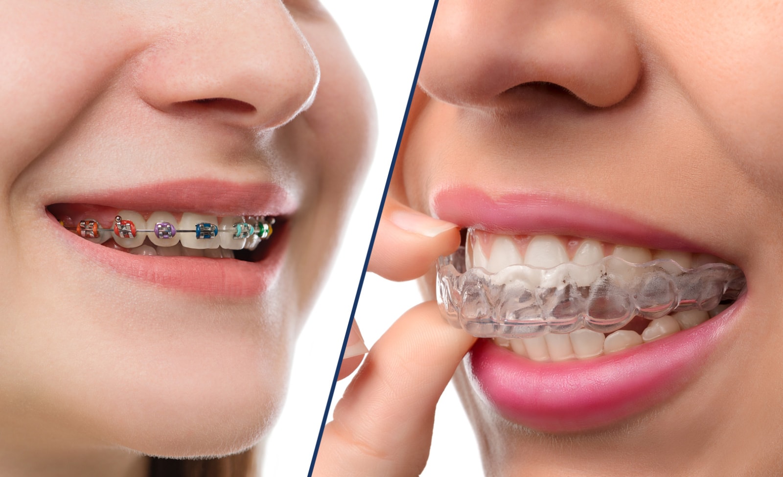 Braces versus Invisalign: Which is Better?