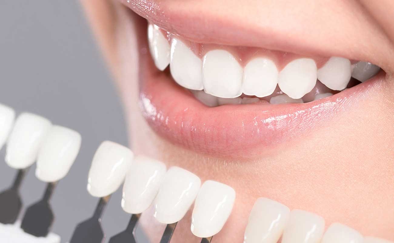 Why Should You Go For Teeth Whitening Treatment?