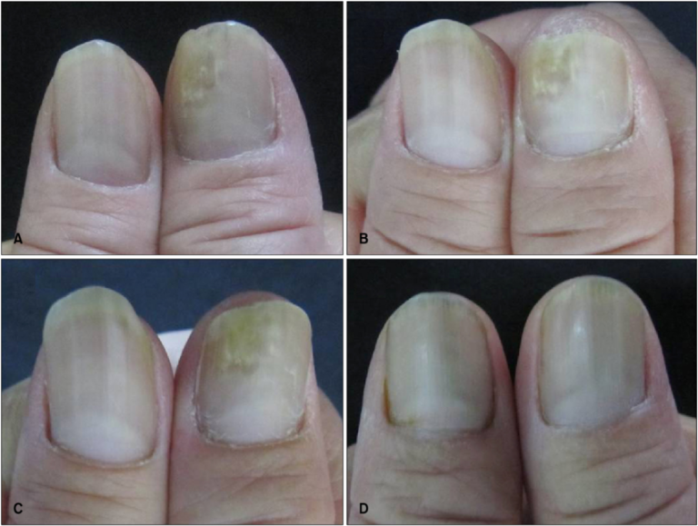 Laser Fungal Nail Treatment: Before and After Instructions